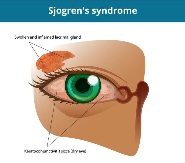 Sjogren's-syndrome