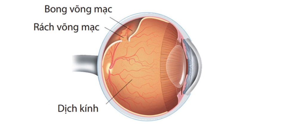 Bong-vong-mac-do-can-thi-nang