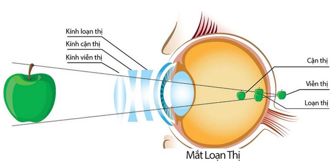 Moi-loai-kinh-dieu-tri-mot-tat-khuc-xa-rieng