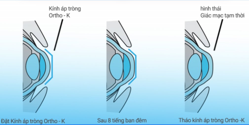 Kinh-ap-trong-ban-dem-co-tac-dung-chinh-hinh-giac-mac