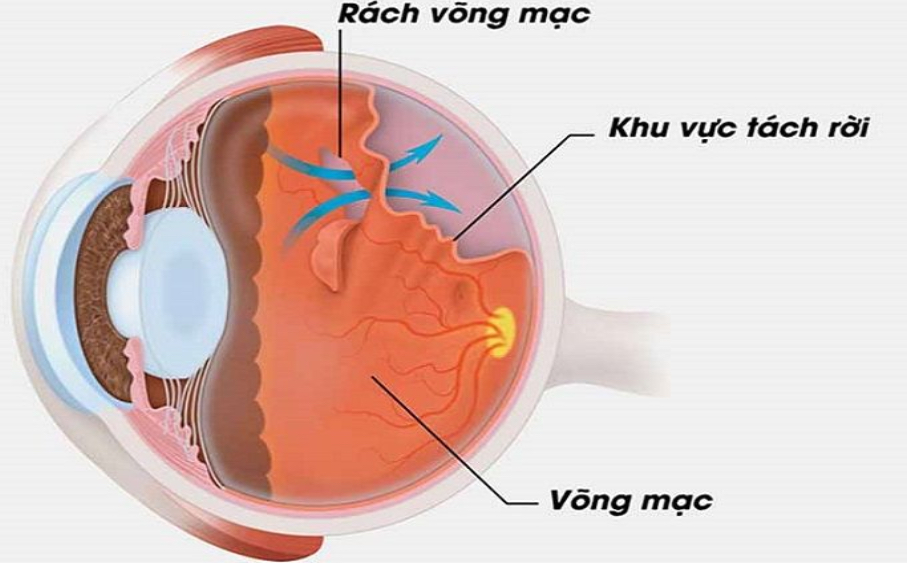 Rach-vong-mac-la-bien-chung-khi-do-can-tang-nhanh