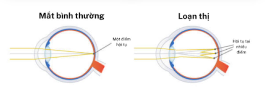 Hình ảnh mắt loạn thị. Dấu hiệu loạn thị là gì?