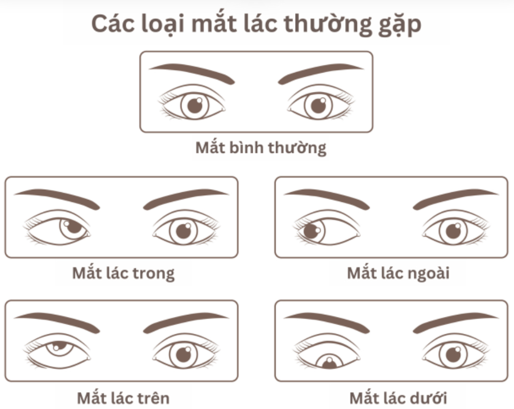 Cac-hinh-thai-lac-mat-thuong-gap