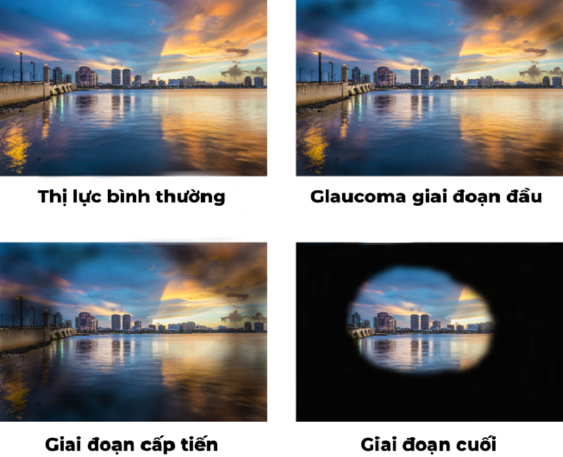 Trieu-chung-cua-benh-glaucoma