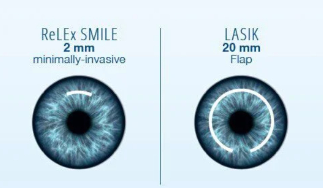 so-sanh-giua-lasik-va-relex-smile