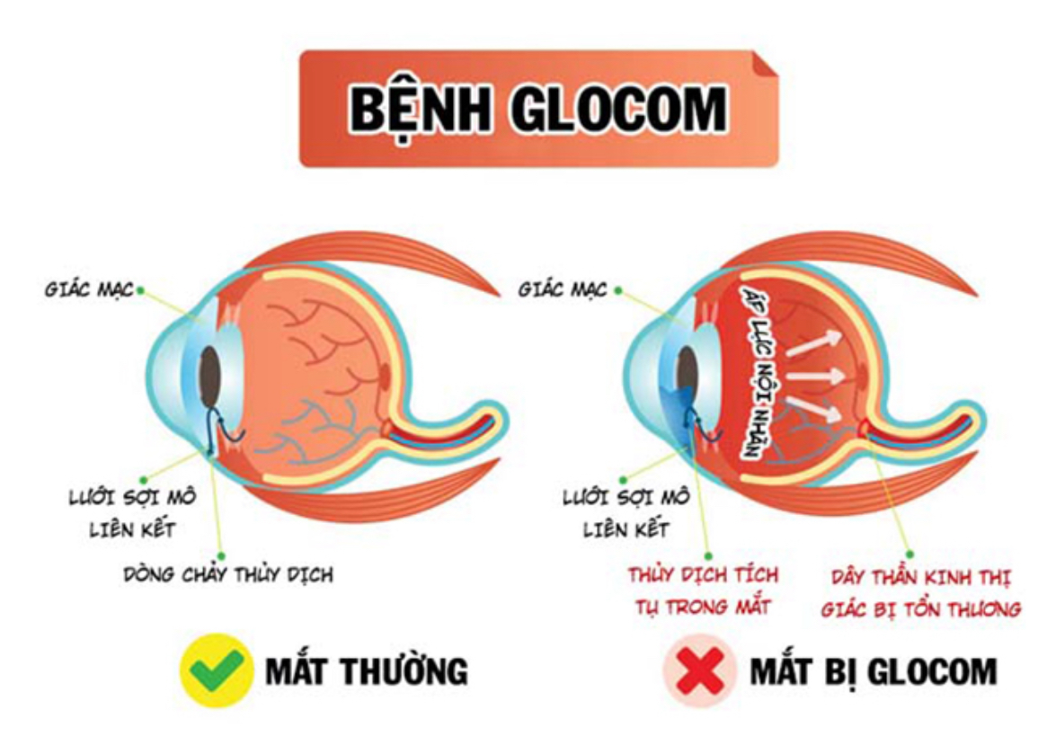 co-che-nhin-mo-trong-benh-glocom