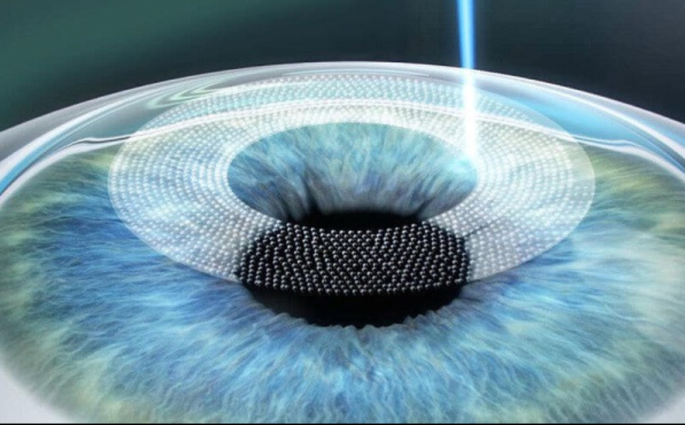 Phuong-phap-ban-mat-Femtosecond-Lasik