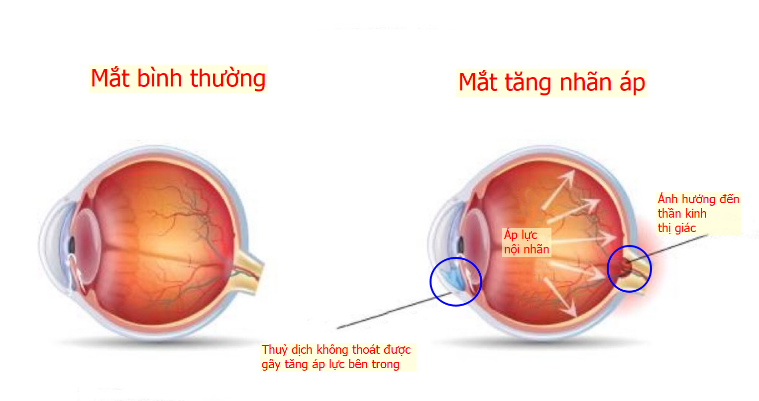 V-rhto-gay-tang-nhan-ap