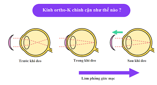 kinh-ap-trong-ban-dem-chinh-can-như-the nao