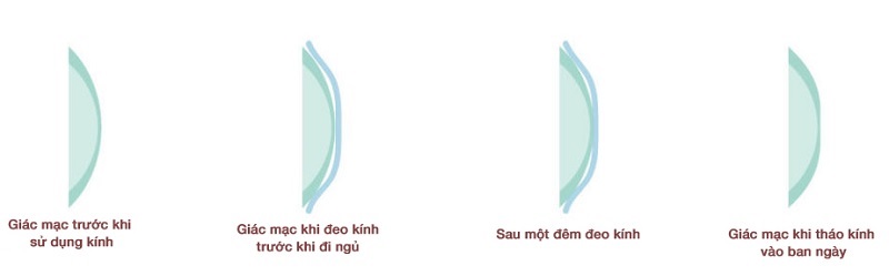 Cơ chế của kính Ortho-K 