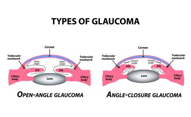 Phan-loai-glocom