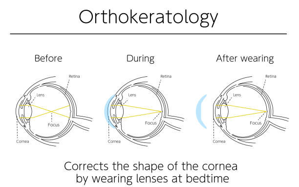 Kinh-ap-trong-Ortho-K 