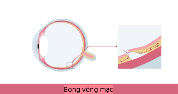 Can-thi-tien-trien-gay-bong-vong-mac