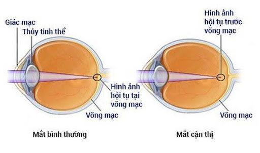 Nguyen-ly-cua-can-thi