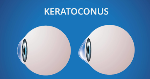 Giac-mac-cua-nguoi-binh-thuong-va-nguoi-mac-Keratoconus-giac-mac-chop