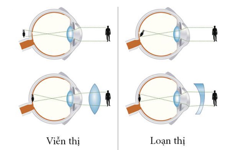 Mắt viễn loạn là mắt vừa bị viễn thị vừa bị loạn thị