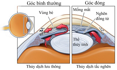 Cơ chế cườm khô, Dấu hiệu bị cườm mắt