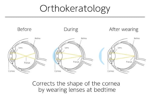 Ortho-K-Kinh-ap-trong-can-thi-deo-ban-dem