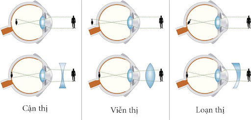 Vien-loan-thi-co-dieu-tri-duoc-khong