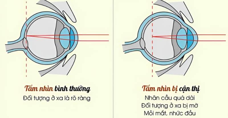 Cận thị (myopia) là một loại tật khúc xạ mà trong đó ánh sáng hội tụ trước võng mạc