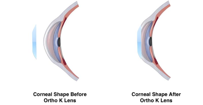 Hiệu quả của Ortho-K đã được chứng minh có thể làm chậm tiến triển cận thị từ 30% đến 60%