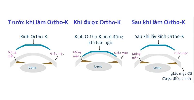 Quá trình sử dụng kính Ortho-K này yêu cầu sự theo dõi và chăm sóc kỹ lưỡng để đảm bảo hiệu quả