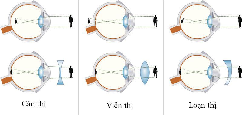 Điều chỉnh kính cho tật khúc xạ