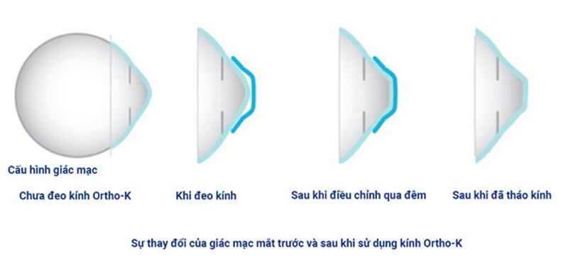 Ortho-k là gì? Có giới hạn độ tuổi dùng phương pháp Ortho-K không?