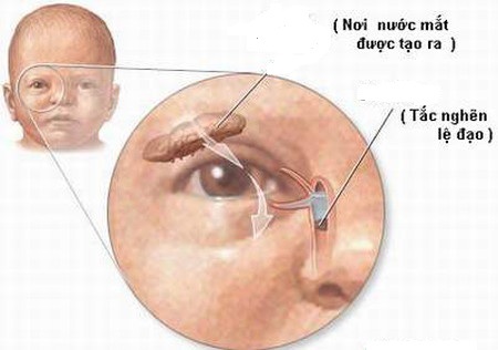 Hình ảnh lệ đạo bị tắc