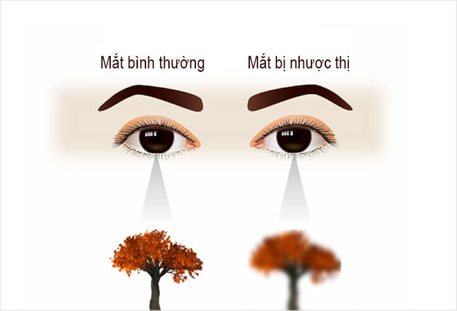 Mắt bị nhược thị