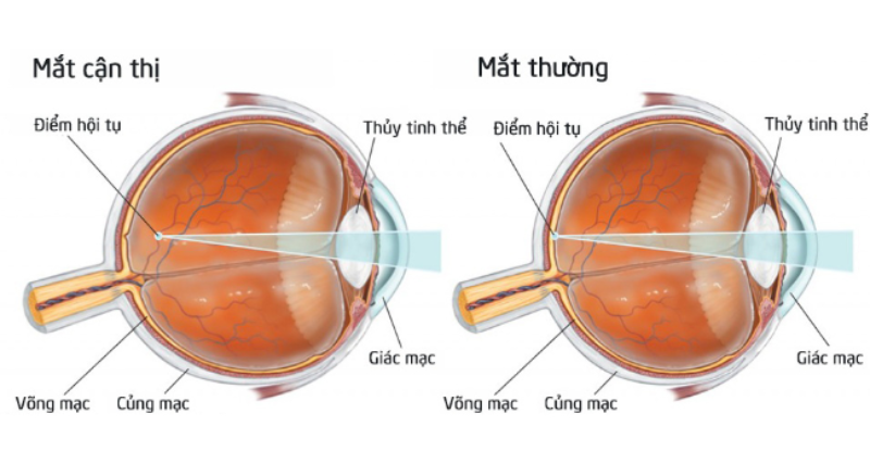 Cận thị là gì?