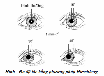 Đo độ lác bằng phương pháp Hirschberg