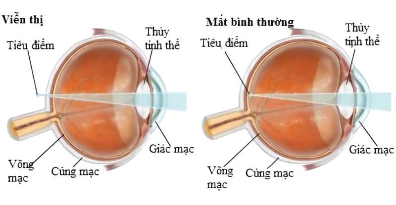 Mắt viễn thị (hyperopia) không thể tập trung ánh sáng chính xác trên võng mạc khi nhìn các vật ở gần