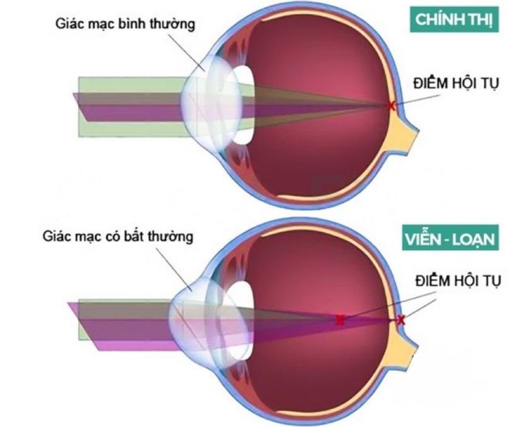 Viễn loạn thị