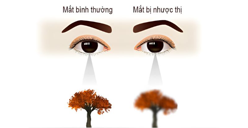 Nhược thị là tình trạng thị lực bị suy giảm ở một hoặc cả hai mắt