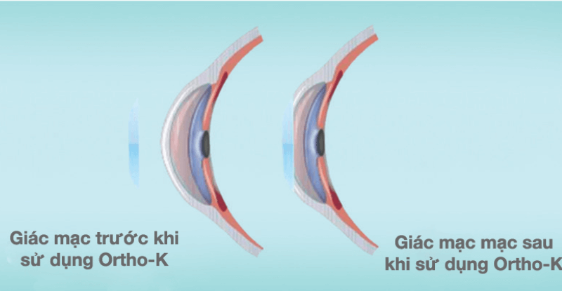 Ortho-K kiểm soát cận thị