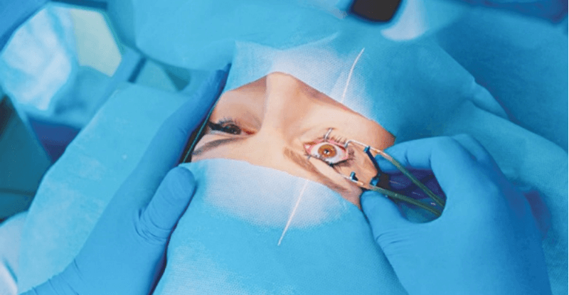 Phẫu thuật LASIK