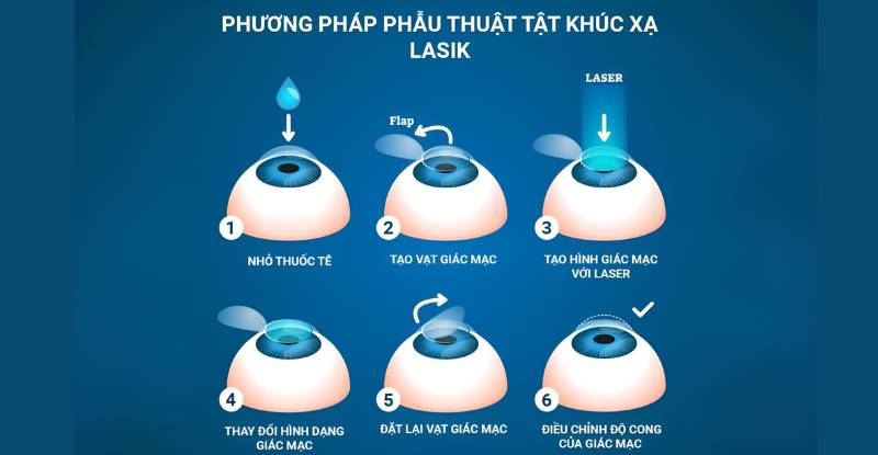 Phương pháp điều trị cận thị phẫu thuật tật khúc xạ Lasik