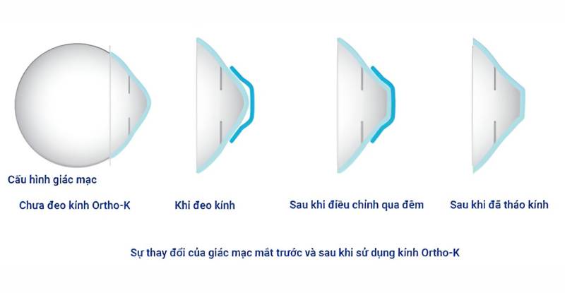 Phương pháp điều trị cận thị kính Ortho-K