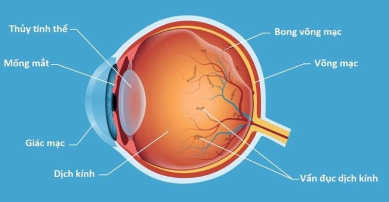 Người bị cận thị nặng có nguy cơ cao mắc bong võng mạc