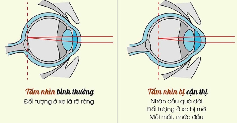 Tầm nhìn bình thường và tầm nhìn bị cận thị