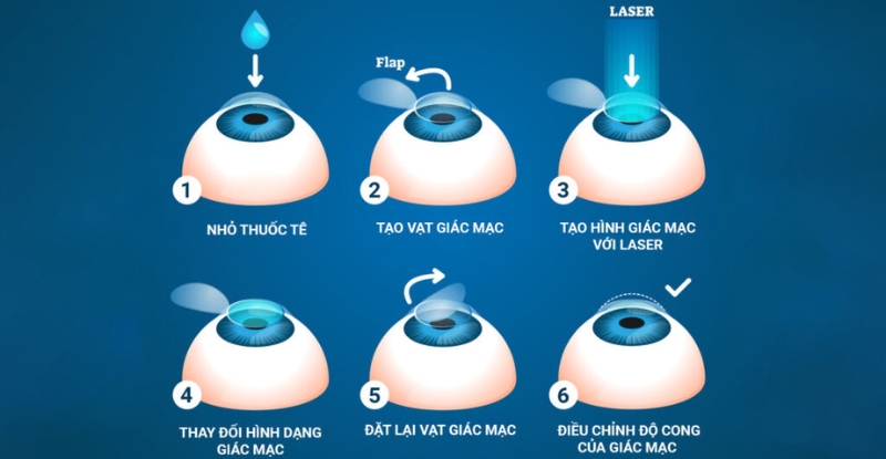 Các bước mổ lasik