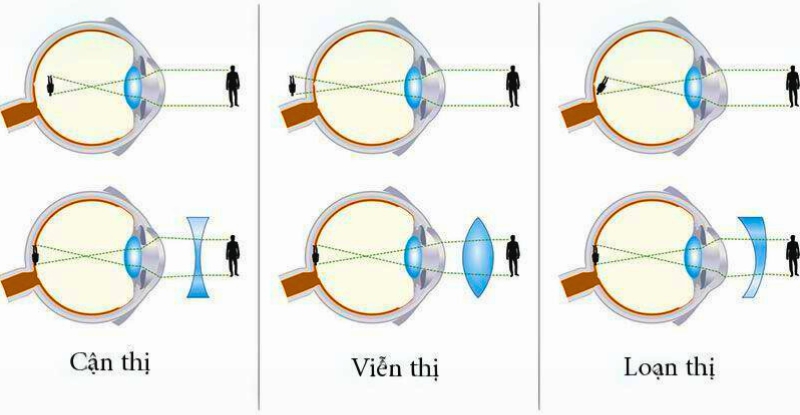 Ortho-k được sử dụng để điều chỉnh các tật khúc xạ mắt