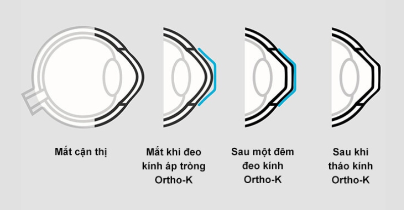 Đeo kính ortho-k khi ngủ giúp định hình giác mạc