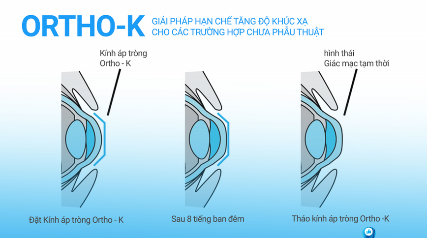 Lợi ích ortho-k đem lại cho người cận thị