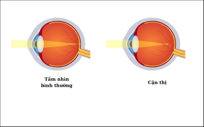 Mắt cận thị không thể nhìn rõ các vật ở xa