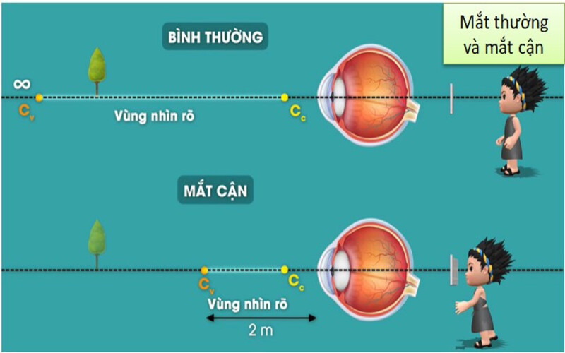 Cận thị là tật khúc xạ cực kỳ phổ biến