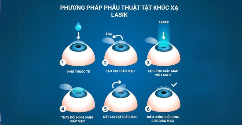 Quá trình phẫu thuật Lasik