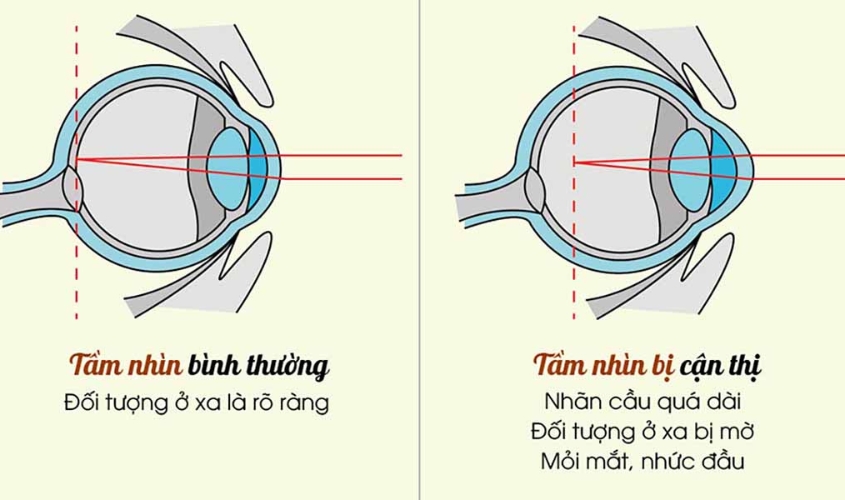 Tấm nhìn mắt bình thường và mắt bị cận thị