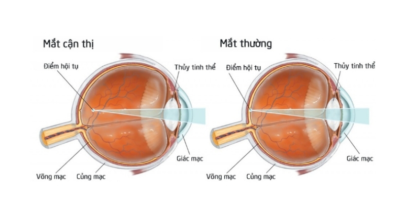 Mắt cận thị và mắt bình thường